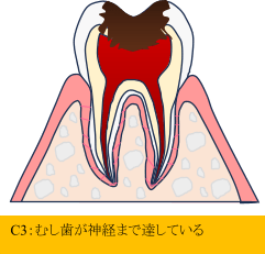 C2:中等度のむし歯