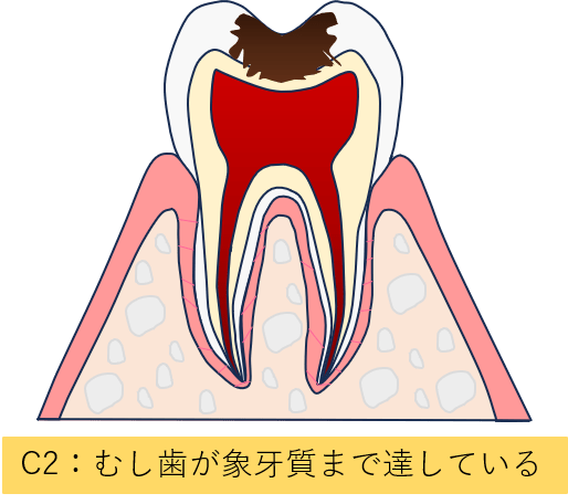 中等度の虫歯（C2）