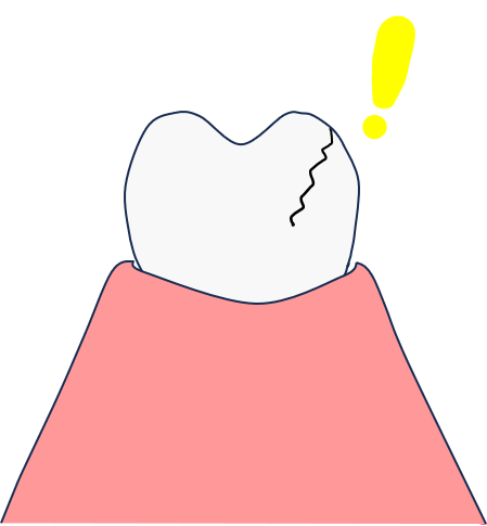 破折とは歯が割れてしまっている状態