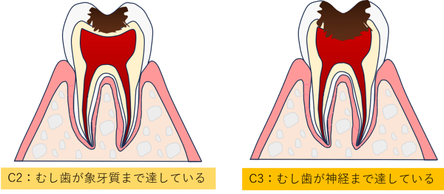 中等度のむし歯（C2）～重度のむし歯（C3）