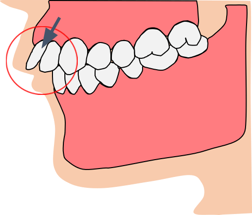 出っ歯と呼ばれる状態
