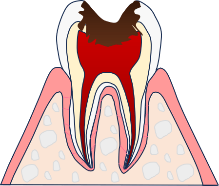 重度の虫歯（C3）とは