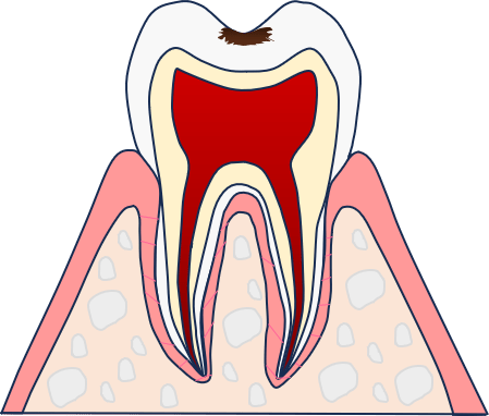 C1:エナメル質まで虫歯が進行