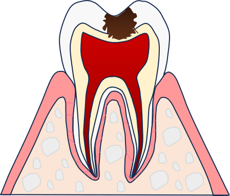C2:象牙質まで虫歯が進行