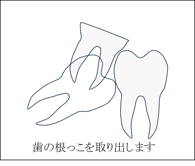 歯の頭が一部だけでている場合の親しらずの抜歯方法3