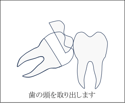 歯の頭が一部だけでている場合の親しらずの抜歯方法2