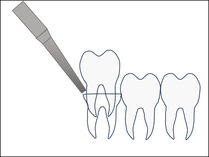 歯の頭がすべて生えている場合の親しらずの抜歯方法2